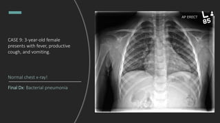 CASE 9: 3-year-old female
presents with fever, productive
cough, and vomiting.
Final Dx: Bacterial pneumonia
Normal chest x-ray!
 
