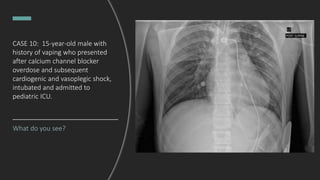 CASE 10: 15-year-old male with
history of vaping who presented
after calcium channel blocker
overdose and subsequent
cardiogenic and vasoplegic shock,
intubated and admitted to
pediatric ICU.
What do you see?
 