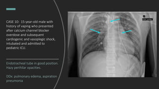Endotracheal tube in good position.
Hazy perihilar opacities.
DDx: pulmonary edema, aspiration
pneumonia
CASE 10: 15-year-old male with
history of vaping who presented
after calcium channel blocker
overdose and subsequent
cardiogenic and vasoplegic shock,
intubated and admitted to
pediatric ICU.
 