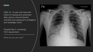 What do you see now?
Hospital Day 2. Increasing
FiO2 requirement.
CASE 10: 15-year-old male with
history of vaping who presented
after calcium channel blocker
overdose and subsequent cardiogenic
and vasoplegic shock.
 