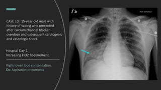 Right lower lobe consolidation.
Dx: Aspiration pneumonia
Hospital Day 2.
Increasing FiO2 Requirement.
CASE 10: 15-year-old male with
history of vaping who presented
after calcium channel blocker
overdose and subsequent cardiogenic
and vasoplegic shock.
 