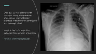 CASE 10: 15-year-old male with
history of vaping who presented
after calcium channel blocker
overdose and subsequent cardiogenic
and vasoplegic shock.
How has the film progressed?
Hospital Day 3. On ampicillin-
sulbactam for aspiration pneumonia.
 