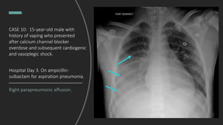 CASE 10: 15-year-old male with
history of vaping who presented
after calcium channel blocker
overdose and subsequent cardiogenic
and vasoplegic shock.
Right parapneumonic effusion.
Hospital Day 3. On ampicillin-
sulbactam for aspiration pneumonia.
 