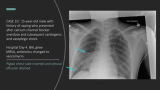 Pigtail chest tube inserted and pleural
effusion drained.
Hospital Day 4. BAL grew
MRSA, antibiotics changed to
vancomycin.
CASE 10: 15-year-old male with
history of vaping who presented
after calcium channel blocker
overdose and subsequent cardiogenic
and vasoplegic shock.
 