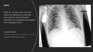 Interpret this chest x-ray.
Hospital Day 8.
CASE 10: 15-year-old male with
history of vaping who presented
after calcium channel blocker
overdose and subsequent cardiogenic
and vasoplegic shock.
 