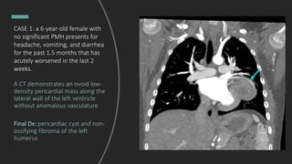 CASE 1: a 6-year-old female with
no significant PMH presents for
headache, vomiting, and diarrhea
for the past 1.5 months that has
acutely worsened in the last 2
weeks.
A CT demonstrates an ovoid low-
density pericardial mass along the
lateral wall of the left ventricle
without anomalous vasculature
Final Dx: pericardiac cyst and non-
ossifying fibroma of the left
humerus
 