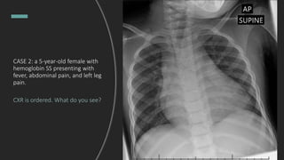 CASE 2: a 5-year-old female with
hemoglobin SS presenting with
fever, abdominal pain, and left leg
pain.
CXR is ordered. What do you see?
 