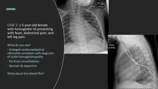 CASE 2: a 5-year-old female
with hemoglobin SS presenting
with fever, abdominal pain, and
left leg pain.
What do you see?
- Enlarged cardiomediastinal
silhouette consistent with diagnosis
of sickle hemoglobinopathy
- No focal consolidations
- Normal rib expansion
What about the lateral film?
 