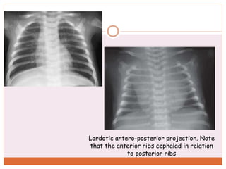 Lordotic View Pediatric chest xray | PPT