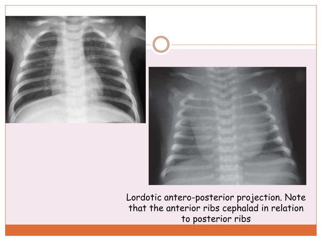 Pediatric chest xray | PPT | Lung and Respiratory Health | Diseases and ...