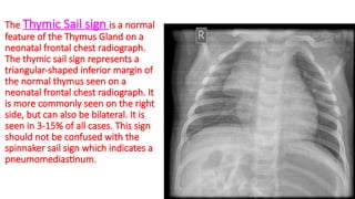 Triangular Sign Chest Pediatric Chest X Ray Dr Hussein Abass 2023.pptx