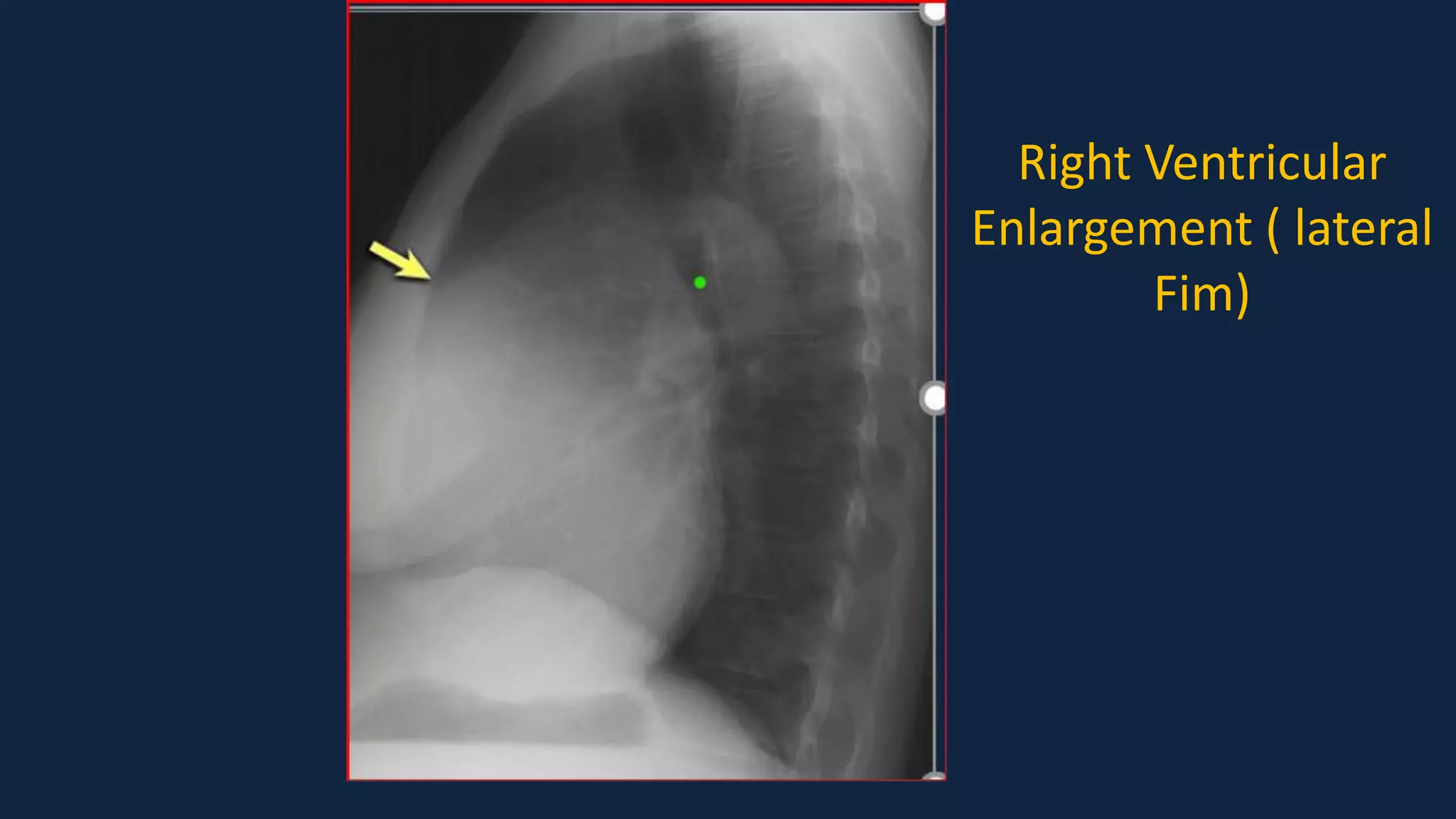 Pediatric Chest x ray Interpretation.pdf