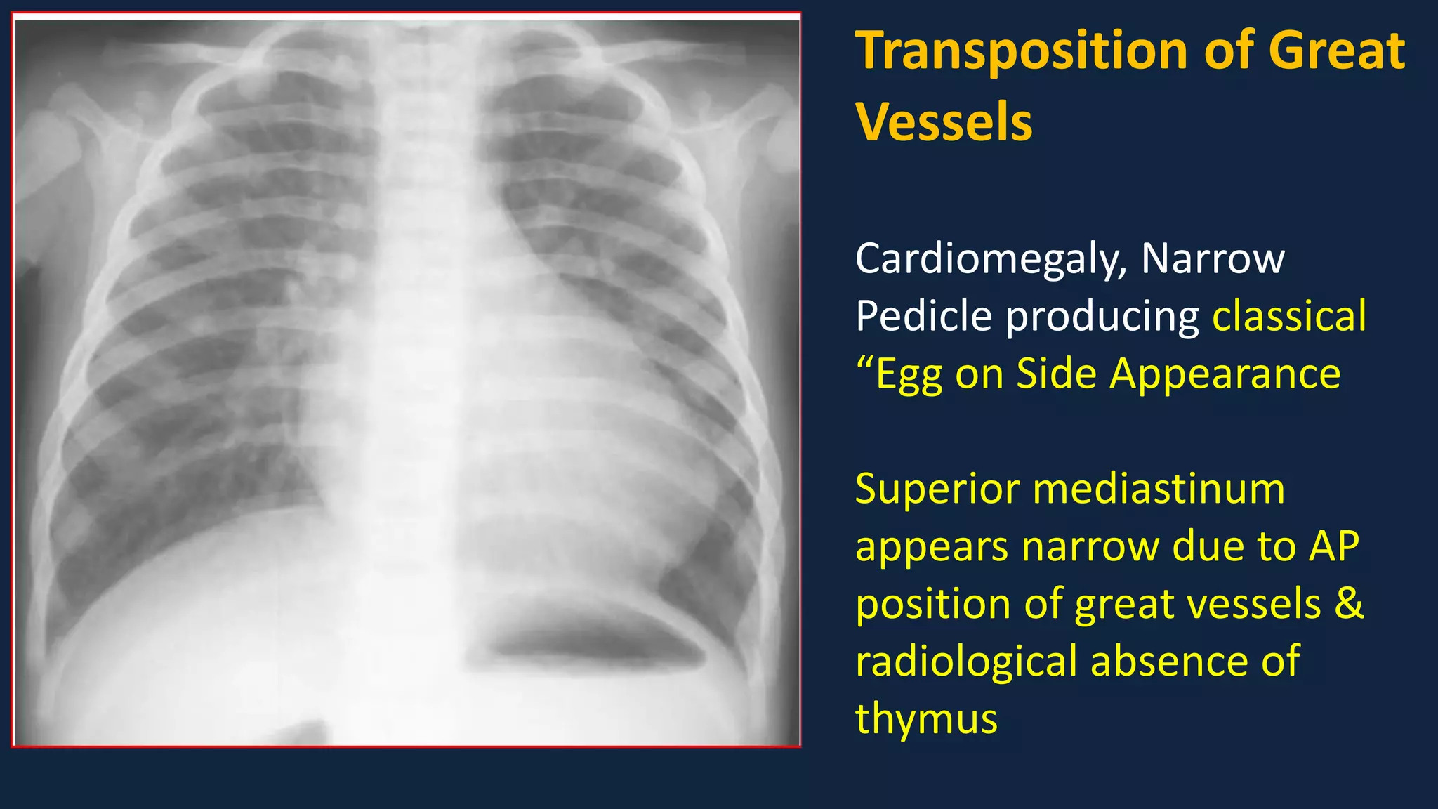 Pediatric Chest x ray Interpretation.pdf