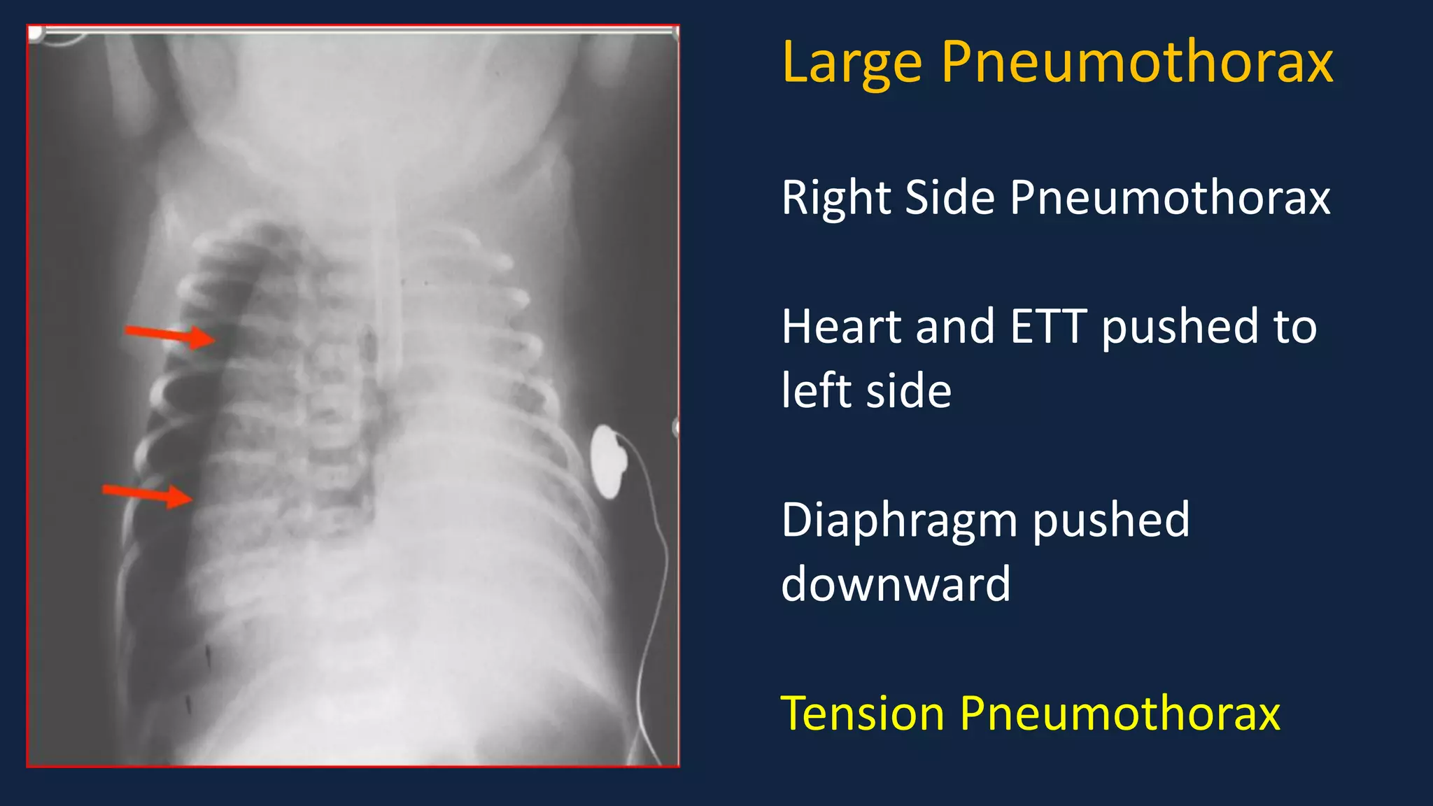 Pediatric Chest X Ray Interpretation pdf pediatric-chest-x-ray-interpretation-pdf
