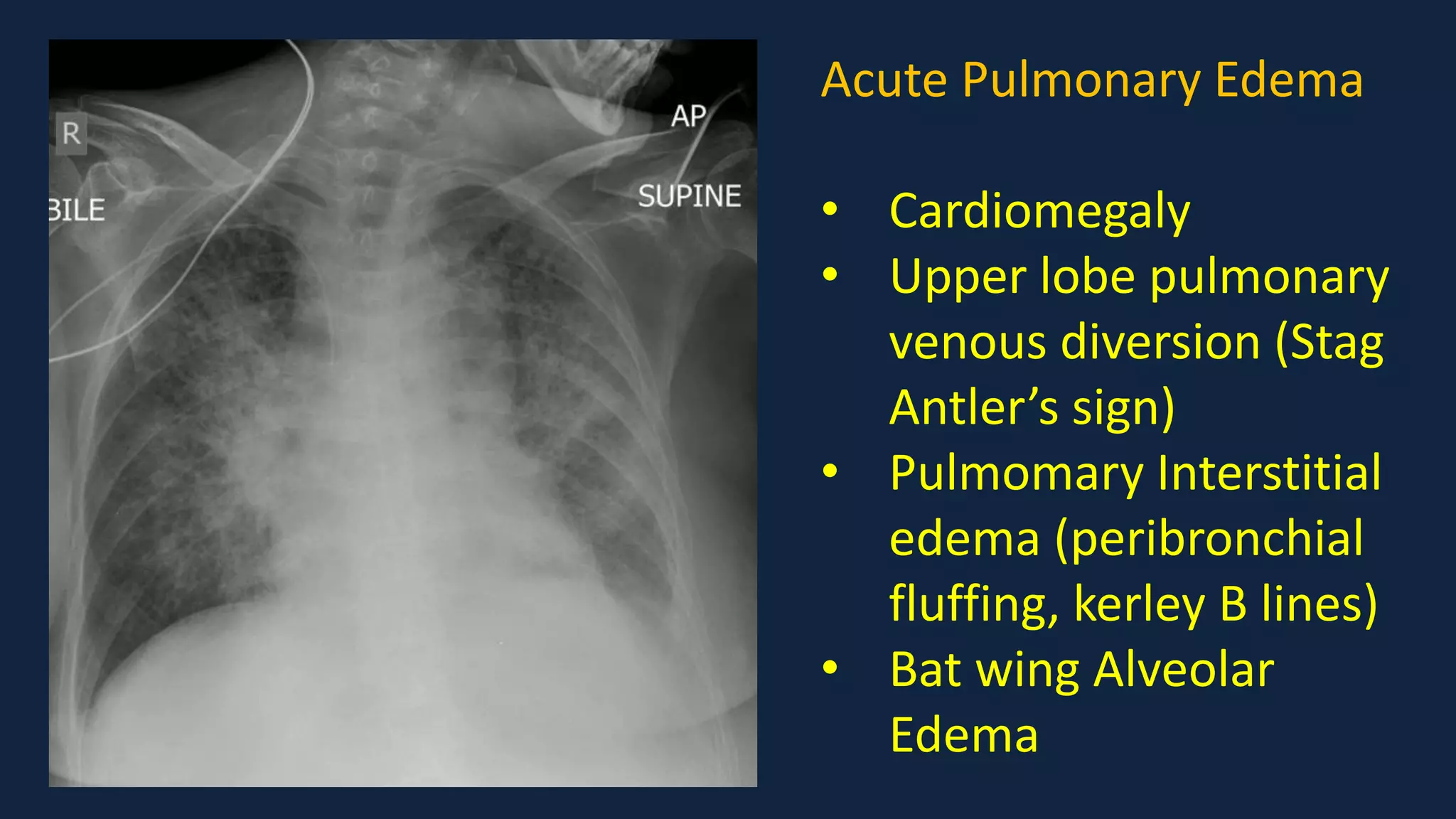 Pediatric Chest x ray Interpretation.pdf