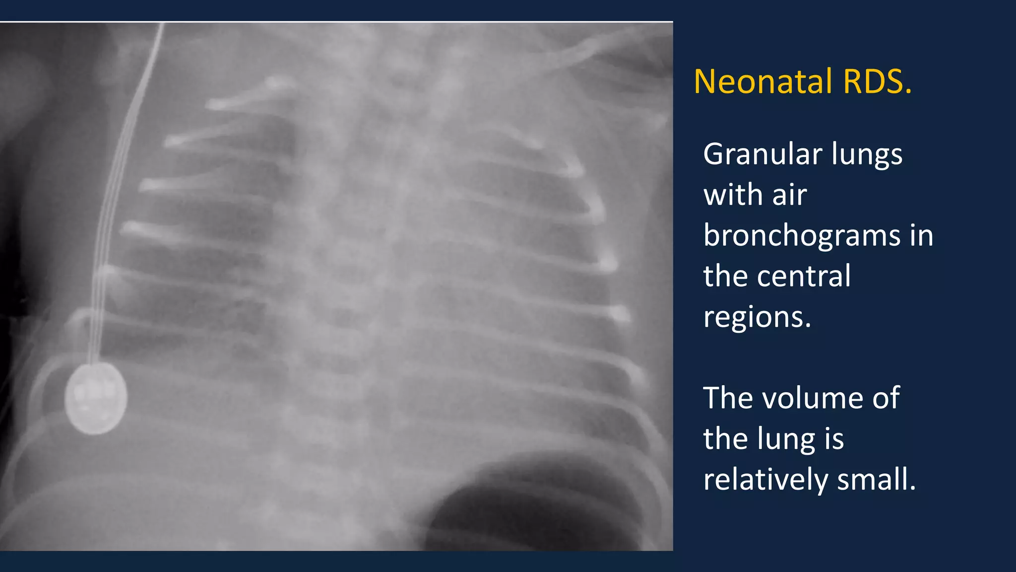 Pediatric Chest x ray Interpretation.pdf