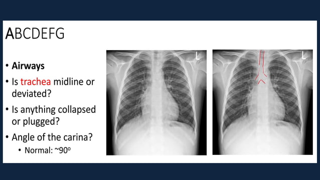 Pediatric Chest x ray Interpretation.pdf