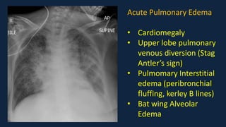 Pediatric Chest x ray Interpretation.pdf