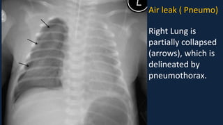 Pediatric Chest x ray Interpretation.pdf