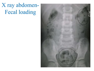 X ray abdomen-
Fecal loading
 