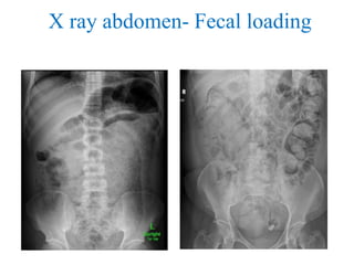 X ray abdomen- Fecal loading
 
