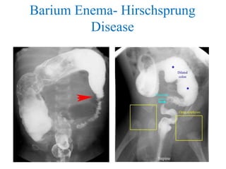 Barium Enema- Hirschsprung
Disease
 