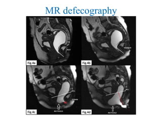 MR defecography
 