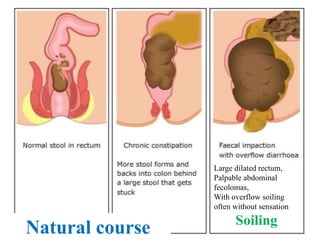 Natural course
Large dilated rectum,
Palpable abdominal
fecolomas,
With overflow soiling
often without sensation
Soiling
 