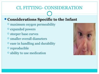 CL FITTING- CONSIDERATION
Considerations Specific to the Infant
 maximum oxygen permeability
 expanded powers
 steeper base curves
 smaller overall diameters
 ease in handling and durability
 reproducible
 ability to use medication
 