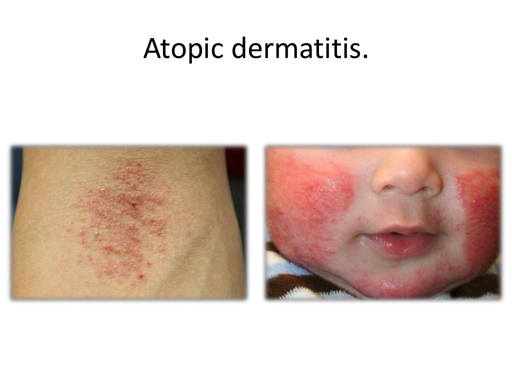 Pediatric dermatology