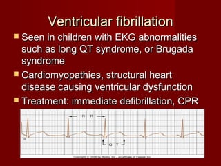 Ventricular fibrillation
 Seen in children with EKG abnormalities
  such as long QT syndrome, or Brugada
  syndrome
 Cardiomyopathies, structural heart
  disease causing ventricular dysfunction
 Treatment: immediate defibrillation, CPR
 