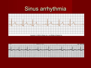Sinus arrhythmia
 