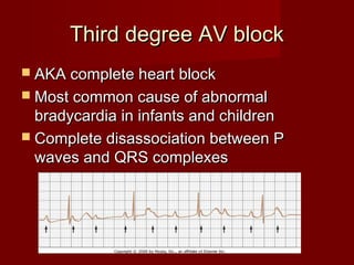Third degree AV block
 AKA complete heart block
 Most common cause of abnormal
  bradycardia in infants and children
 Complete disassociation between P
  waves and QRS complexes
 