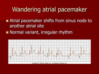 Pediatric Dysrhythmias.ppt