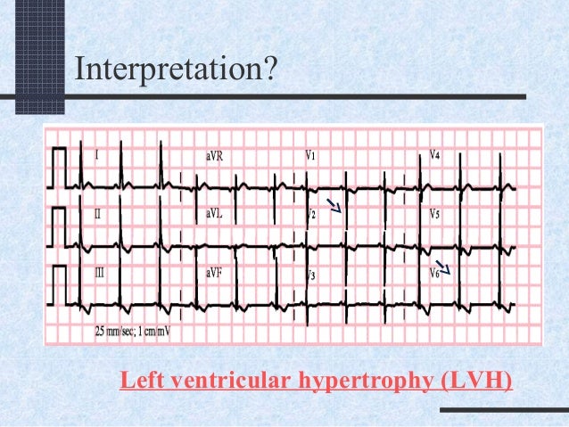 Pediatric Ecg