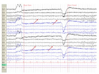 Pediatric EEG.pptx