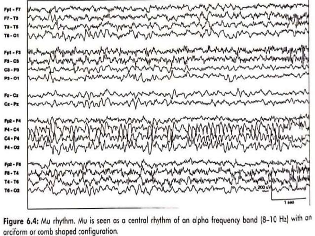 Pediatric EEG.pptx | Brain and Nervous System Disorders | Diseases and ...