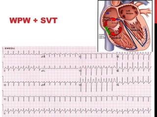 Wpw Svt Algorithm Pediatric EKGs | PPTX