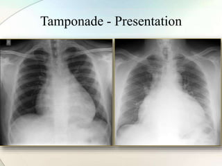 Tamponade - Presentation
 