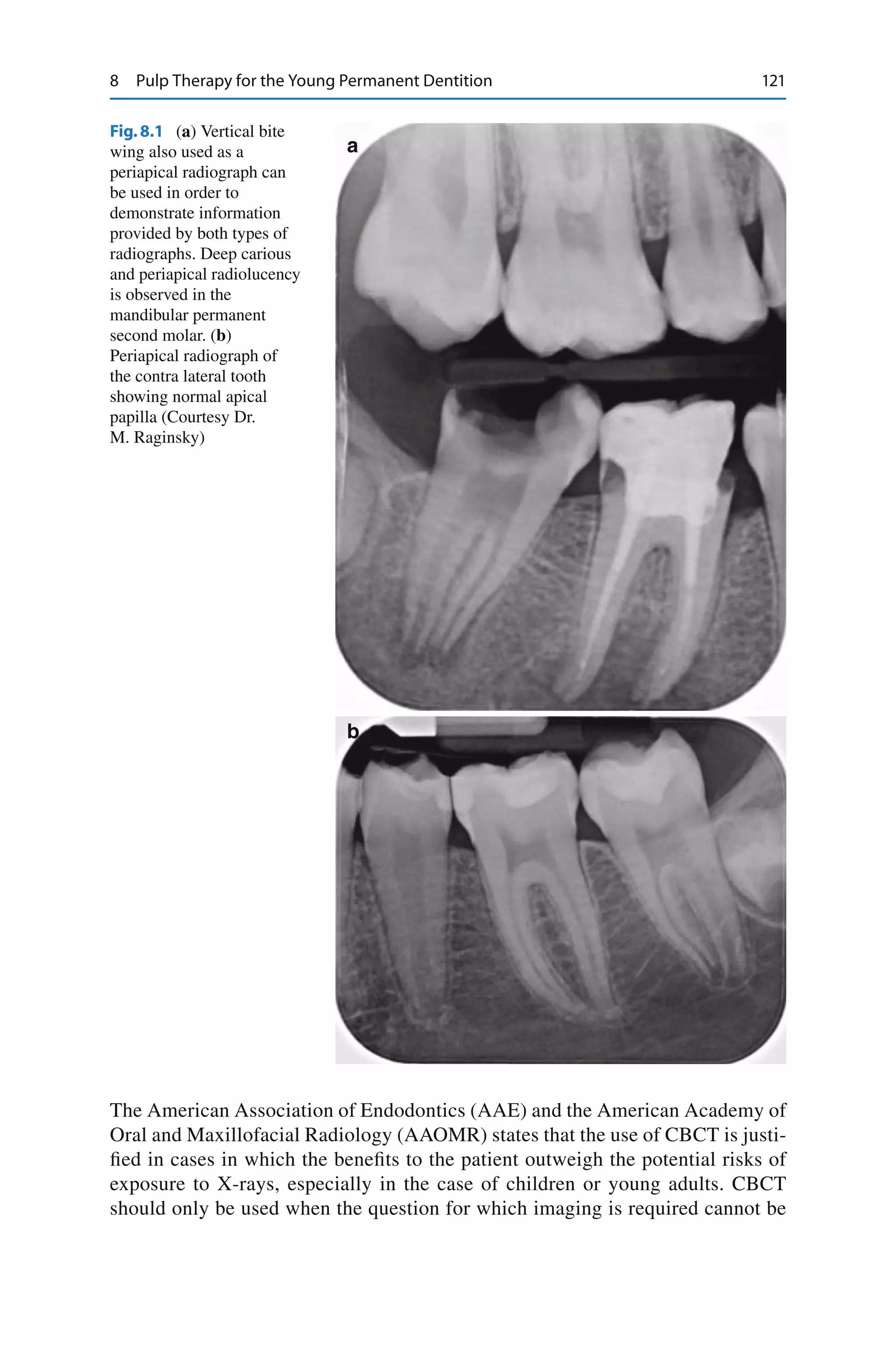 Pediatric Endodontics_ Current Concepts in Pulp Therapy for Primary and ...