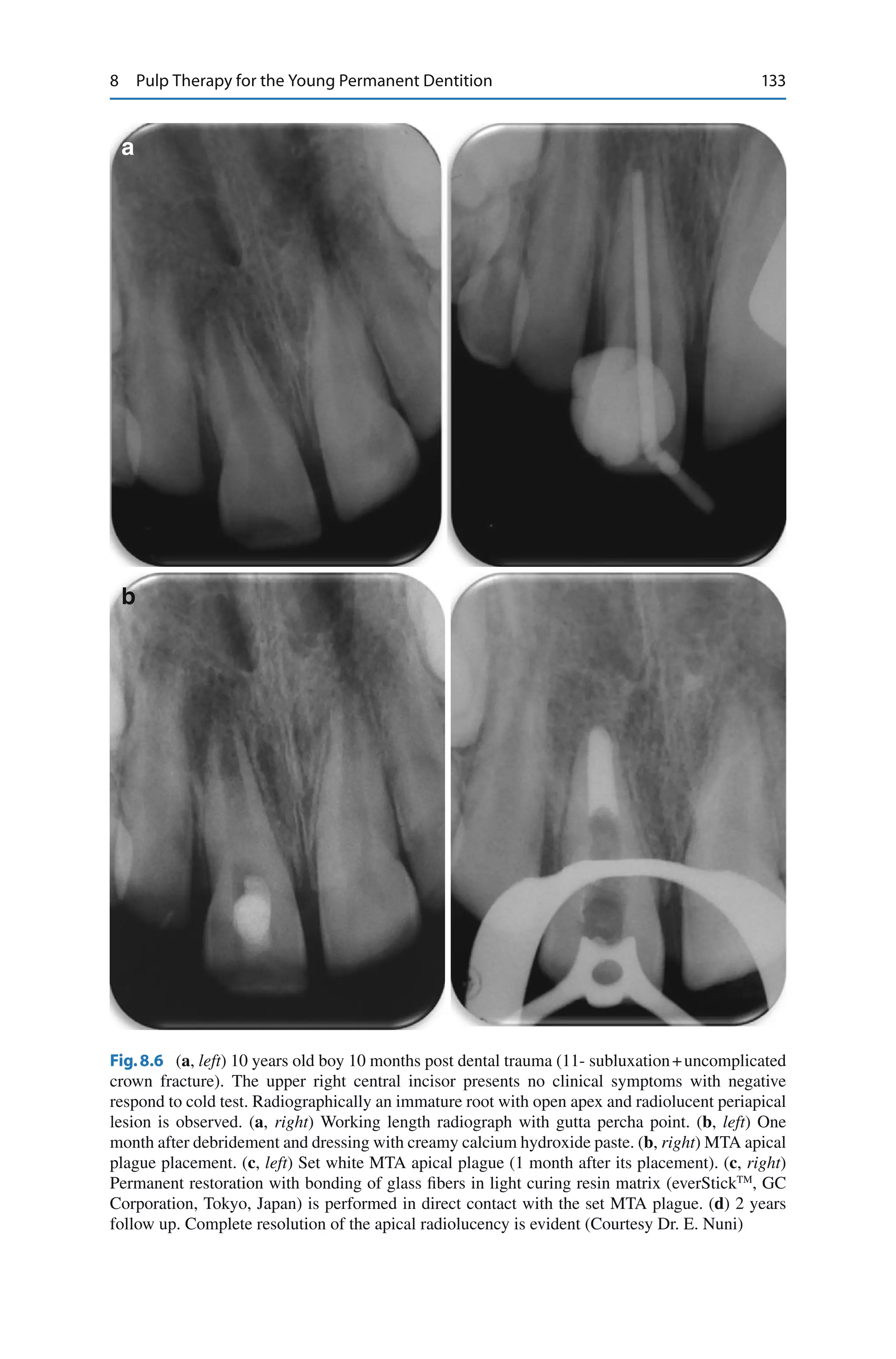 Pediatric Endodontics_ Current Concepts in Pulp Therapy for Primary and ...