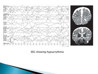 Pediatric epilepsy syndromes | PPTX