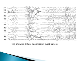 Pediatric epilepsy syndromes | PPTX