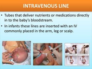 Iv Line Tracing pediatric equipments.pptx
