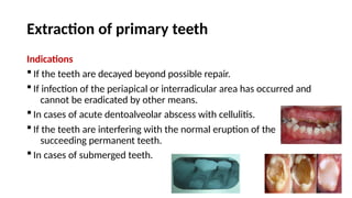 Eruption Abscess how to treat and extract pediatric teeth | PPTX