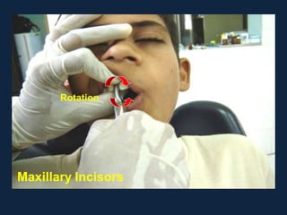 Pediatric Exodontia.pptx