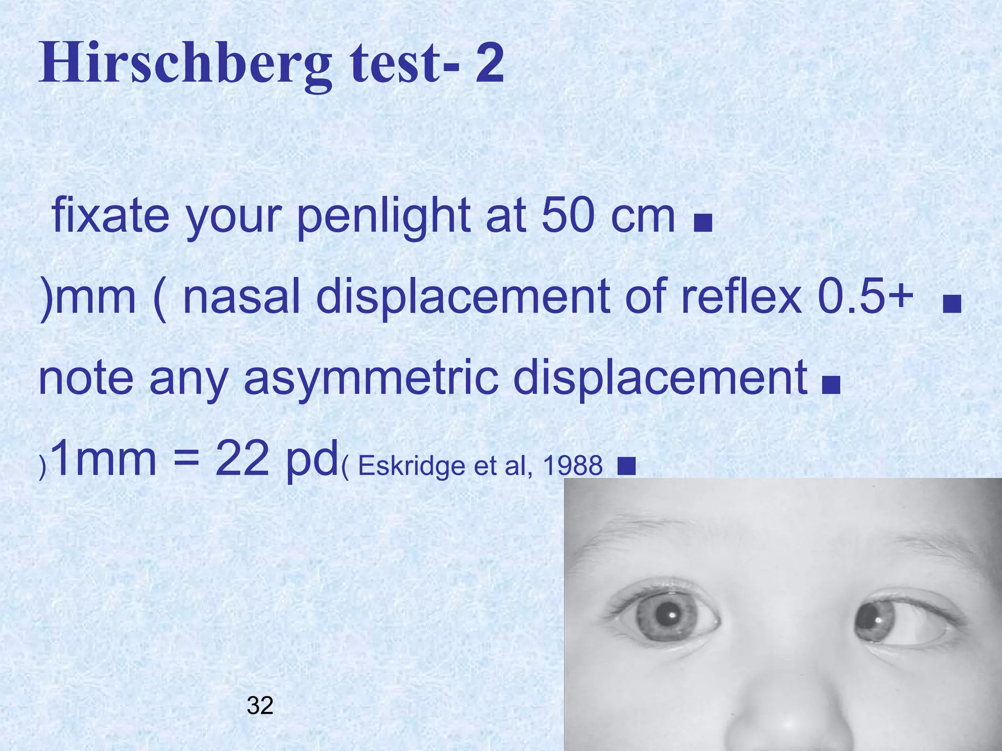 Hirschberg test- 2
fixate your penlight at 50 cm ■
(mm ( nasal displacement of reflex 0.5+
note any asymmetric displacement ■
(

1mm = 22 pd( Eskridge et al, 1988 ■

32

■

 