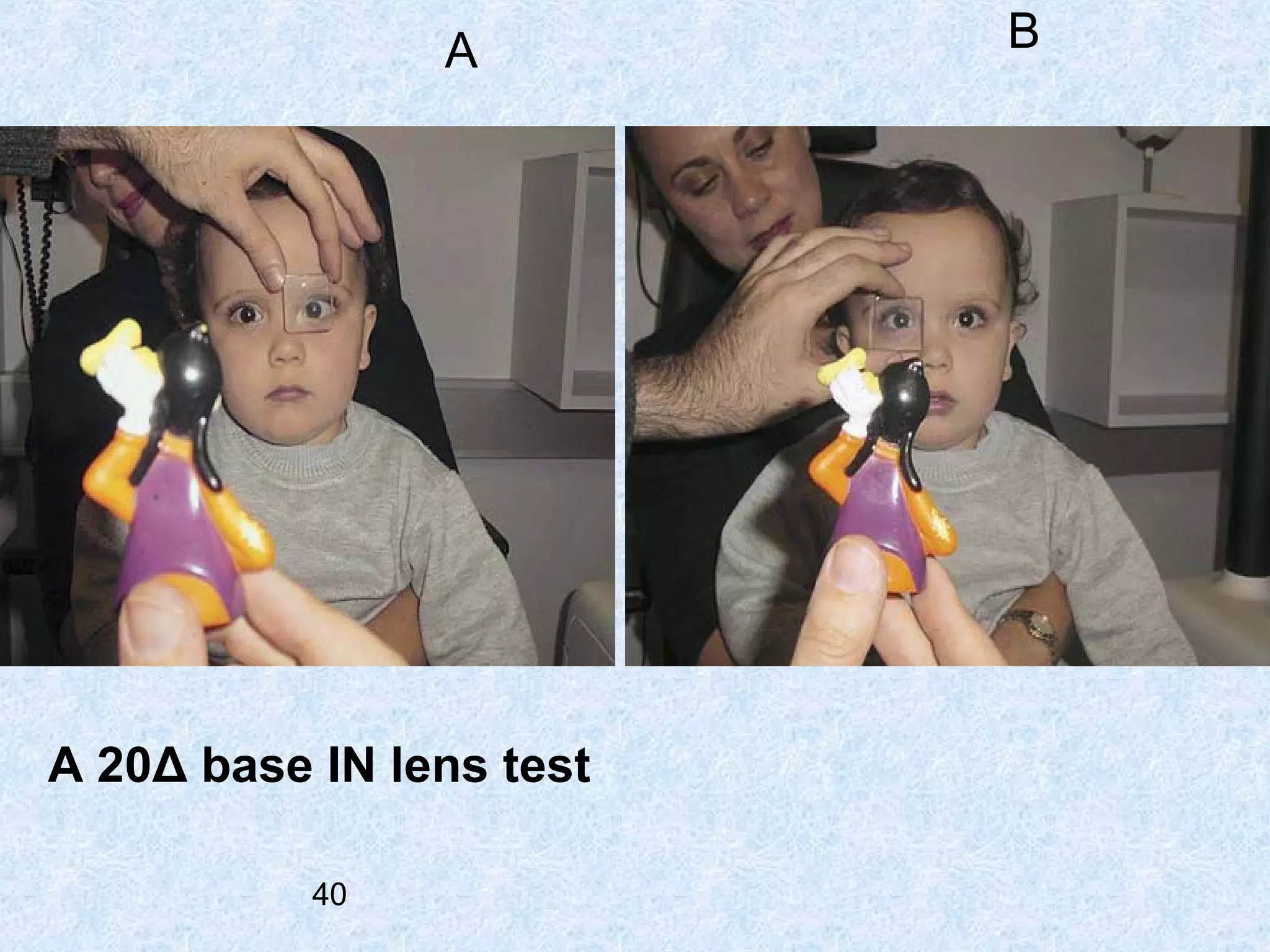 A

A 20Δ base IN lens test
40

B

 