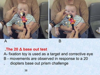 Pediatric eye and vision | PPT