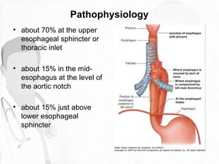 Pathophysiology
Patients are at an increased risk if they are
• Small
• have an underlying esophageal disease such as a
st...
